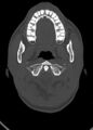 Arrow injury to the head (Radiopaedia 75266-86388 Axial bone window 36).jpg