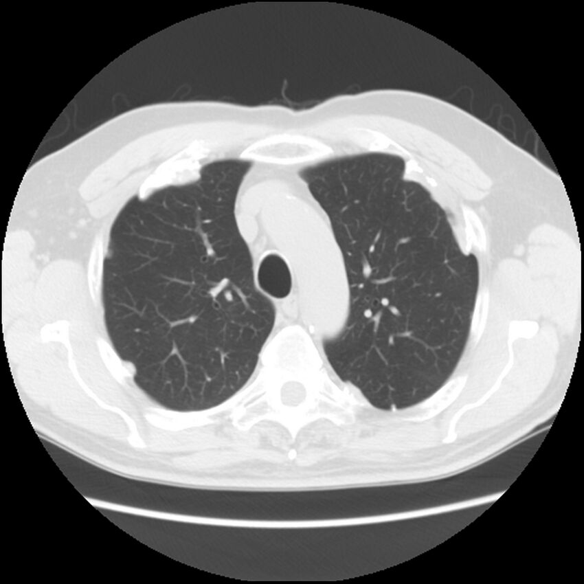 Asbestos-related pleural plaques (Radiopaedia 39069-41255 Axial lung window 20).jpg