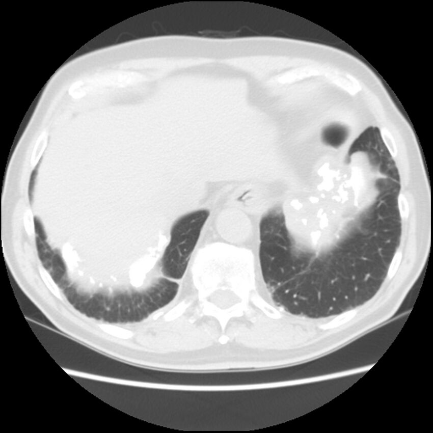 Asbestos-related pleural plaques (Radiopaedia 39069-41255 Axial lung window 61).jpg
