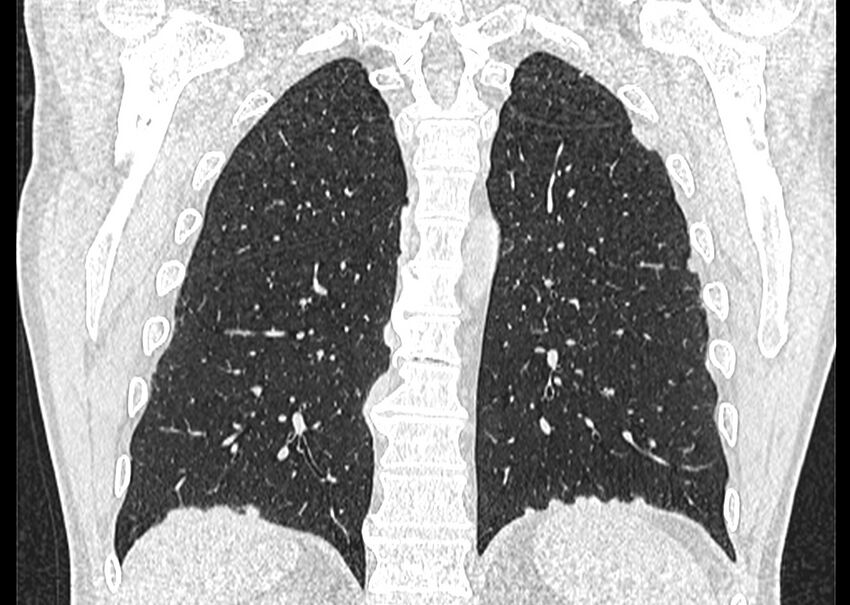 Asbestos pleural placques (Radiopaedia 57905-64872 Coronal lung window 217).jpg