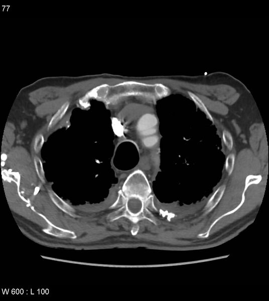 File:Asbestos related lung and pleural disease (Radiopaedia 14377-14301 D 13).jpg