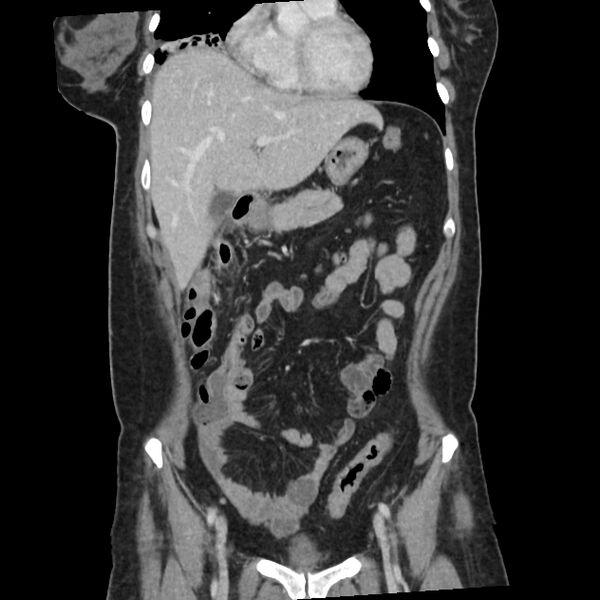 File:Ascending retrocecal appendicitis with liver abscesses (Radiopaedia 60066-67615 C 29).jpg
