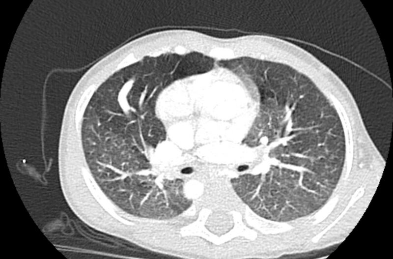 File:Asplenia syndrome (Radiopaedia 73083-83792 Axial lung window 30).jpg