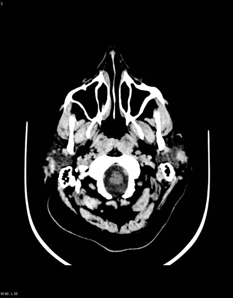 File:Astroblastoma (Radiopaedia 39792-42216 Axial non-contrast 2).jpg