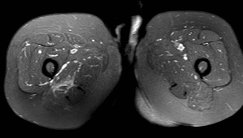 Atypical lipomatous tumor - thigh (Radiopaedia 68975-78734 Axial PD fat sat 67).jpg
