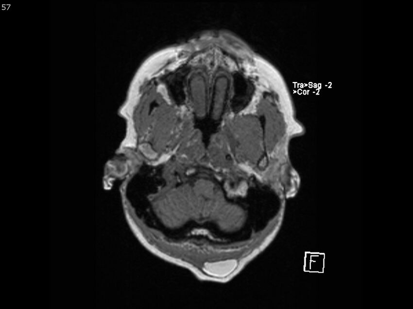Atypical meningioma - intraosseous (Radiopaedia 64915-74572 Axial T1 57).jpg