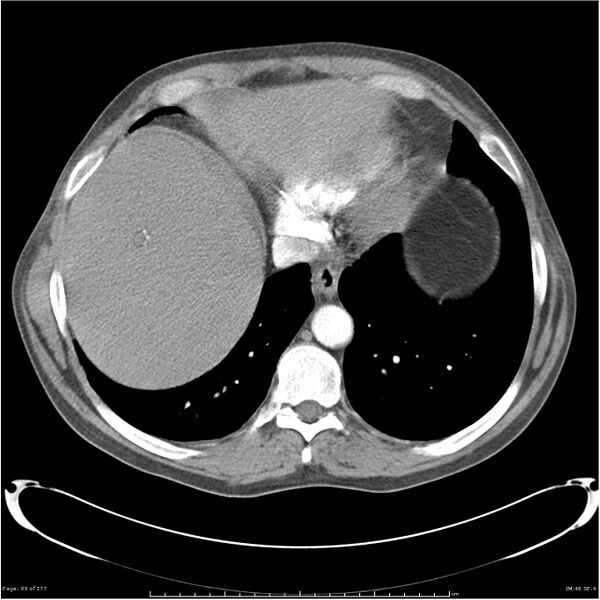 File:Atypical pneumonia - Q fever (Radiopaedia 21993-21989 C+ arterial phase 41).jpg