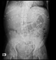 Autosomal dominant polycystic kidney disease (Radiopaedia 11222).jpg