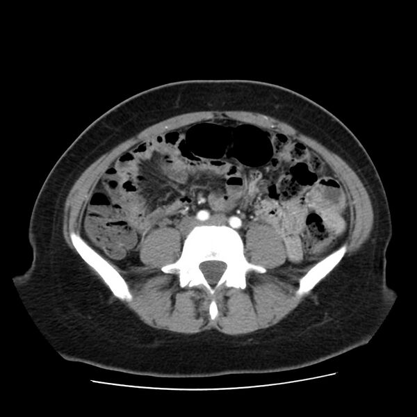 File:Autosomal dominant polycystic kidney disease (Radiopaedia 23061-23093 B 45).jpg