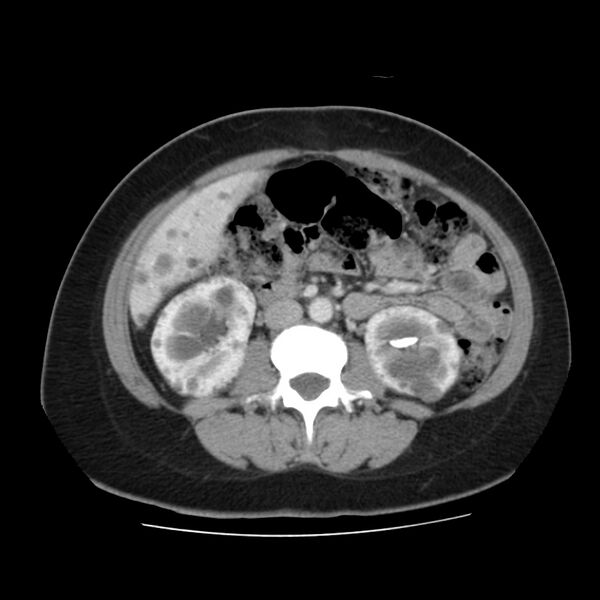 File:Autosomal dominant polycystic kidney disease (Radiopaedia 23061-23093 C 34).jpg