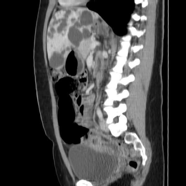 File:Autosomal dominant polycystic kidney disease (Radiopaedia 23061-23093 F 32).jpg