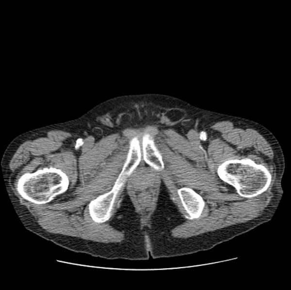 File:Autosomal dominant polycystic kidney disease (Radiopaedia 27851-28094 B 124).jpg