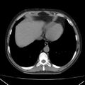 Autosomal dominant polycystic kidney disease (Radiopaedia 36539-38101 Axial non-contrast 7).jpg