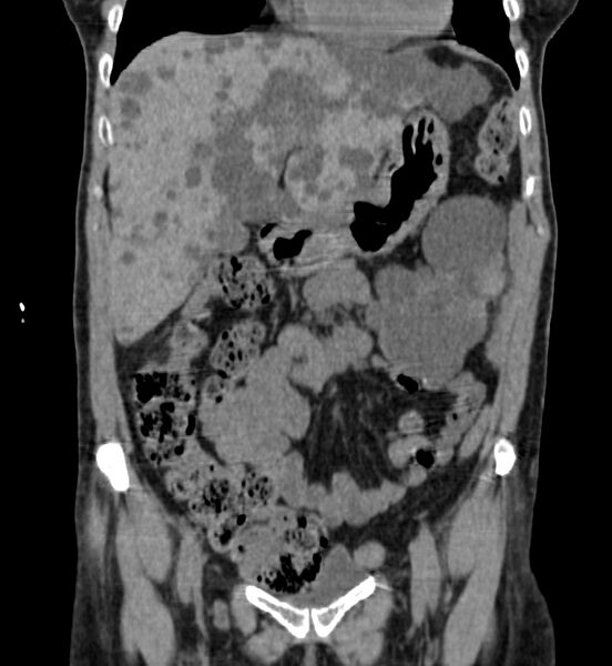 File:Autosomal dominant polycystic kidney disease (Radiopaedia 41918-44922 Coronal non-contrast 6).jpg
