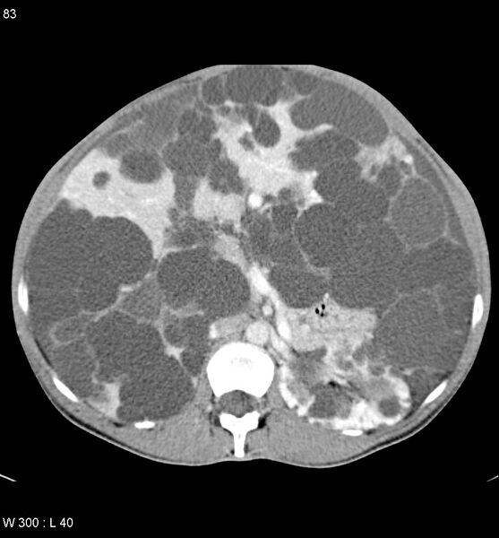 File:Autosomal dominant polycystic kidney disease with extensive hepatic involvement (Radiopaedia 5204-6971 B 10).jpg