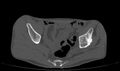 Avascular necrosis of the left hip (Radiopaedia 75068-86125 Axial bone window 9).jpg