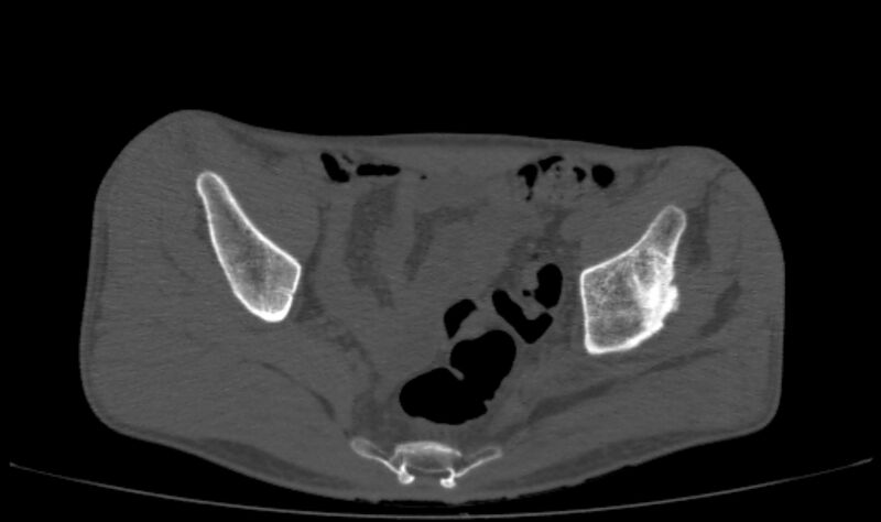 File:Avascular necrosis of the left hip (Radiopaedia 75068-86125 Axial bone window 9).jpg