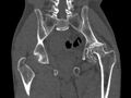Avascular necrosis of the left hip (Radiopaedia 75068-86125 Coronal bone window 52).jpg