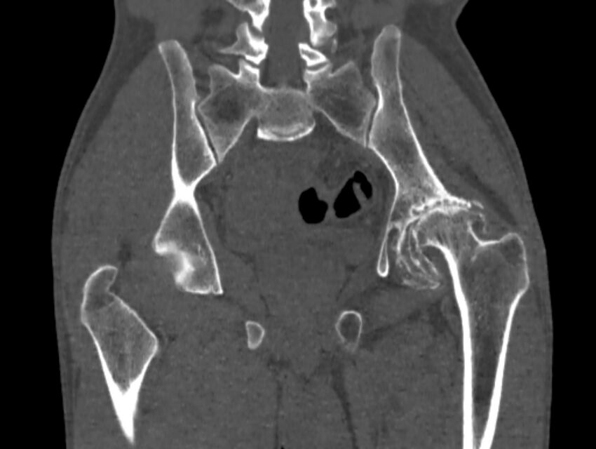 Avascular necrosis of the left hip (Radiopaedia 75068-86125 Coronal bone window 52).jpg