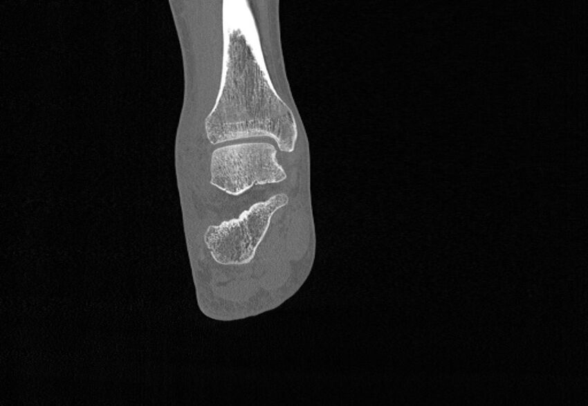 Avulsion fractures of talus and calcaneus (Radiopaedia 48277-53155 Coronal bone window 61).jpg
