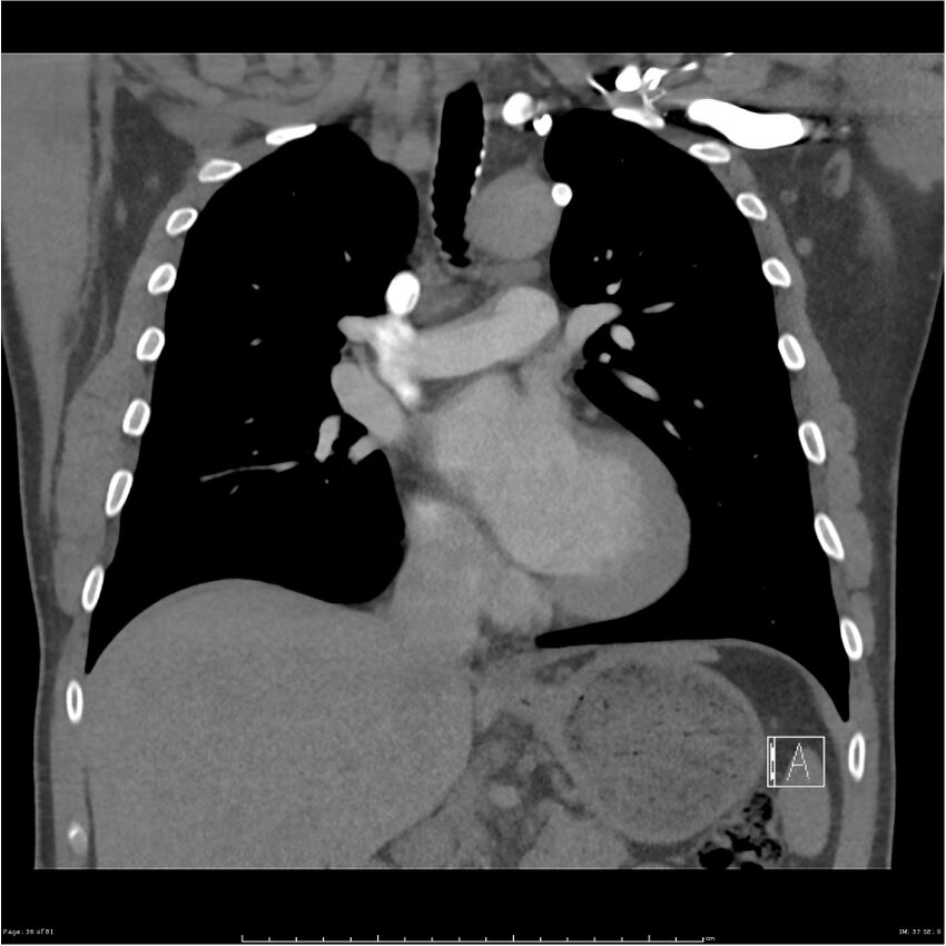 Azygos venous system anatomy (CT pulmonary angiography) (Radiopaedia 25928-26077 Coronal C+ CTPA 36).jpg