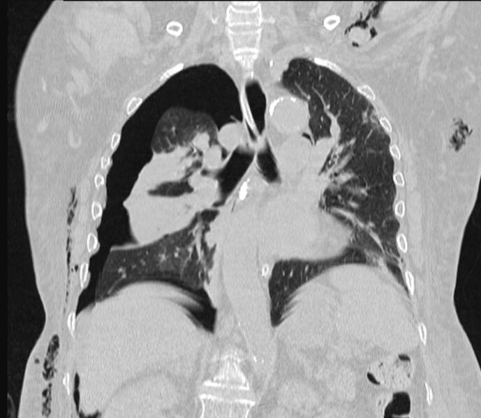 File:Barotrauma due to mechanical ventilation (Radiopaedia 28079-28336 Coronal lung window 57).jpg