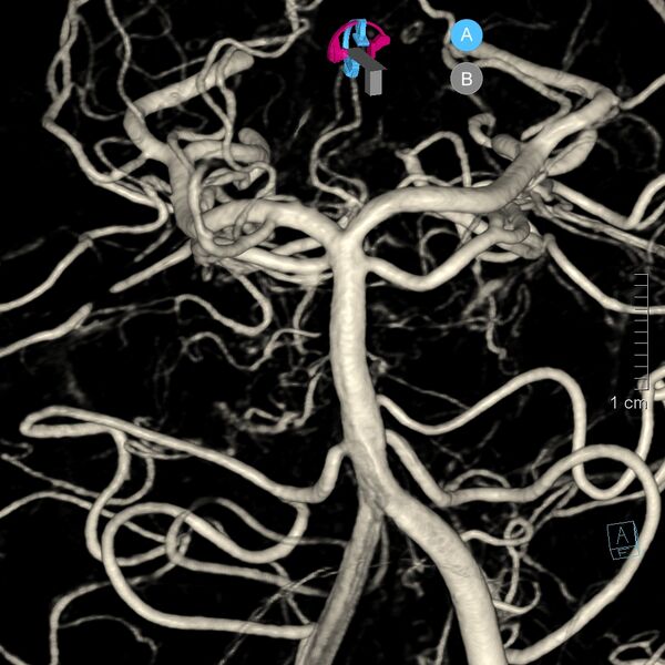File:Basilar artery perforator aneurysm (Radiopaedia 82455-97734 3D view left VA 41).jpg