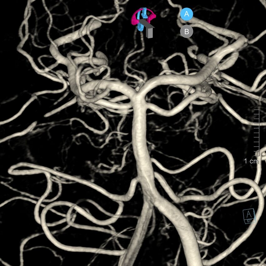 Basilar artery perforator aneurysm (Radiopaedia 82455-97734 3D view left VA 41).jpg