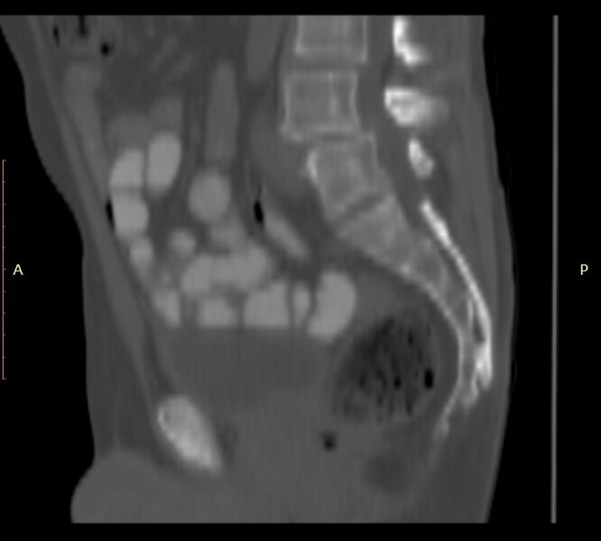 File:Bertolotti syndrome (Radiopaedia 58974-66235 Sagittal bone window 27).jpg