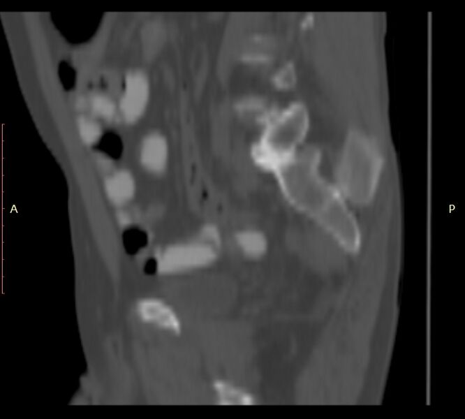 File:Bertolotti syndrome (Radiopaedia 58974-66235 Sagittal bone window 43).jpg