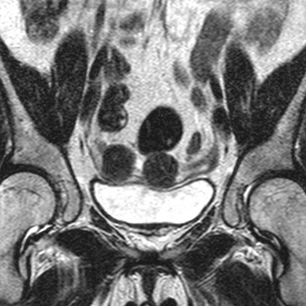 File:Bicornuate uterus (Radiopaedia 11104-11492 Coronal T2 5).jpg