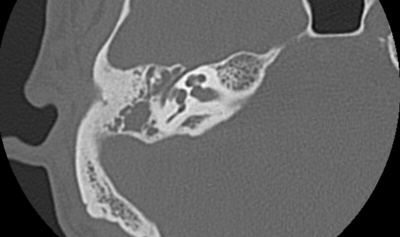 File:Bilateral cholesteatoma (Radiopaedia 54898-61172 Axial bone window 24).jpg