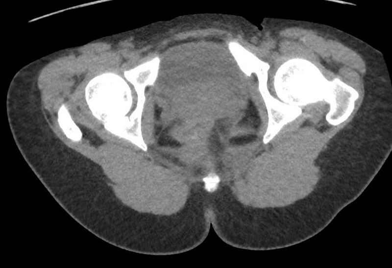 File:Bilateral mature cystic ovarian teratoma (Radiopaedia 88821-105592 Axial non-contrast 53).jpg