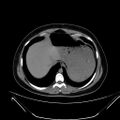 Bilateral ovarian mature cystic teratomas (Radiopaedia 79373-92457 Axial non-contrast 1).jpg