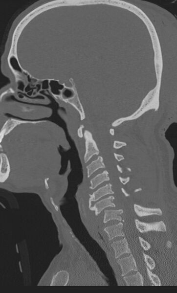 File:Bilateral perched facet joint (Radiopaedia 63149-71669 Sagittal bone window 34).jpg