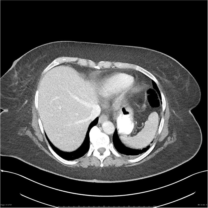 Bilateral psoas hematomas (Radiopaedia 24057-24279 A 11).jpg