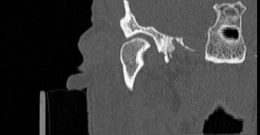 Bilateral temporal bone fractures (Radiopaedia 29482-29970 Coronal non-contrast 52).jpg