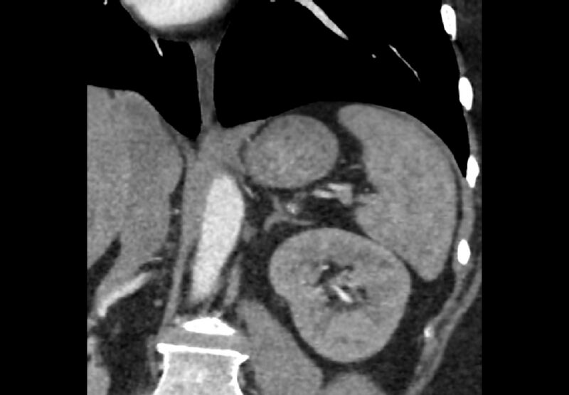 File:Bilateral urolithiasis with incidentally detected splenic artery aneurysm and left inferior vena cava (Radiopaedia 44467-48127 Ob. Cor. C+ Art. 3).jpg
