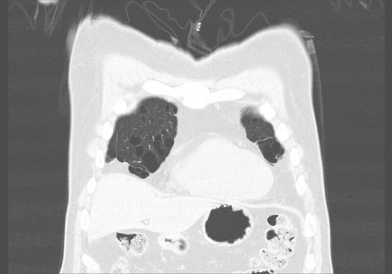 File:Birt-Hogg-Dubé syndrome (Radiopaedia 52578-58491 Coronal lung window 3).jpg
