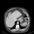 Bladder papillary urothelial carcinoma (Radiopaedia 48119-52951 Axial 4).png