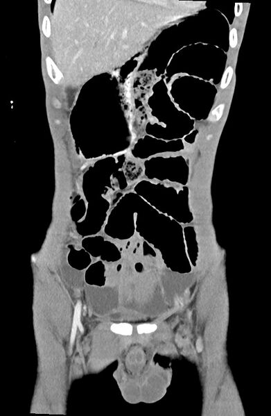 File:Blunt injury to the small bowel (Radiopaedia 74953-85987 B 24).jpg
