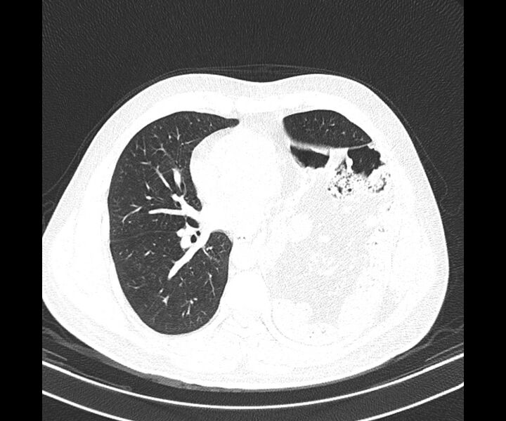 File:Bochdalek hernia - adult presentation (Radiopaedia 74897-85925 Axial lung window 26).jpg