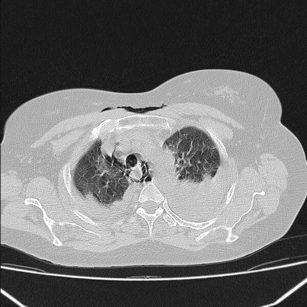 File:Boerhaave syndrome (Radiopaedia 45644-49799 Axial lung window 41).jpg