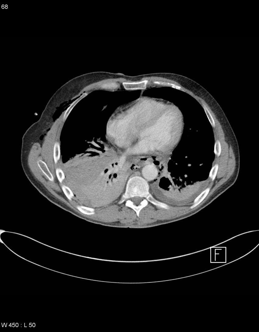 Boerhaave syndrome with tension pneumothorax (Radiopaedia 56794-63605 A 33).jpg