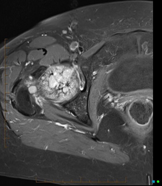 File:Bone metastasis - breast cancer (Radiopaedia 16667-16374 Axial T1 C+ fat sat 10).jpg