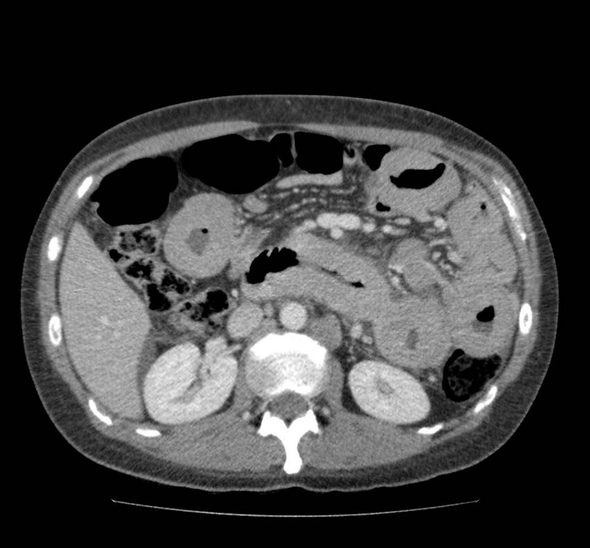 Bowel lymphoma complicated by bleeding after therapy (Radiopaedia 55601-62107 A 34).jpg