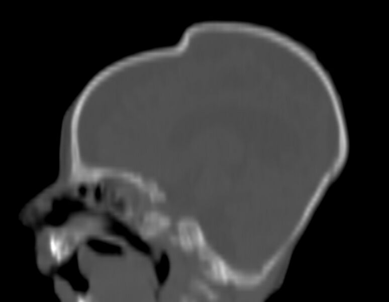 File:Brachycephaly (bi-coronal and bi-lambdoid synostosis) (Radiopaedia 55048-61413 Sagittal bone window 14).jpg
