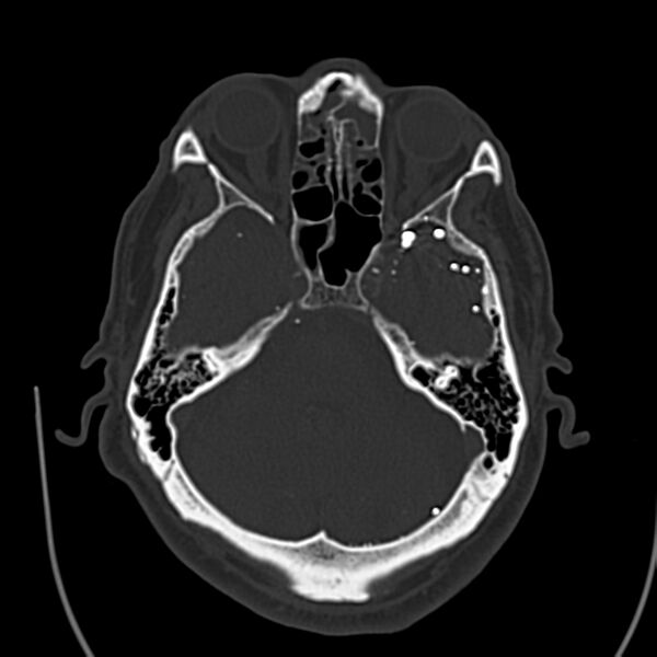 File:Brain Pantopaque remnants (Radiopaedia 78403-91048 Axial bone window 25).jpg