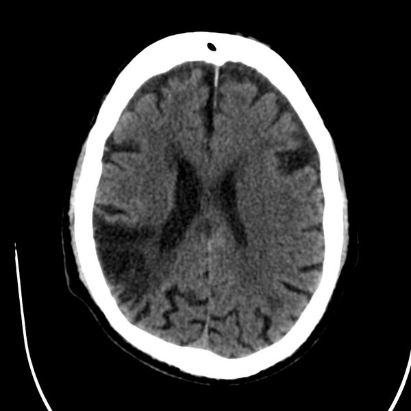 File:Brain Pantopaque remnants (Radiopaedia 78403-91048 Axial non-contrast 60).jpg