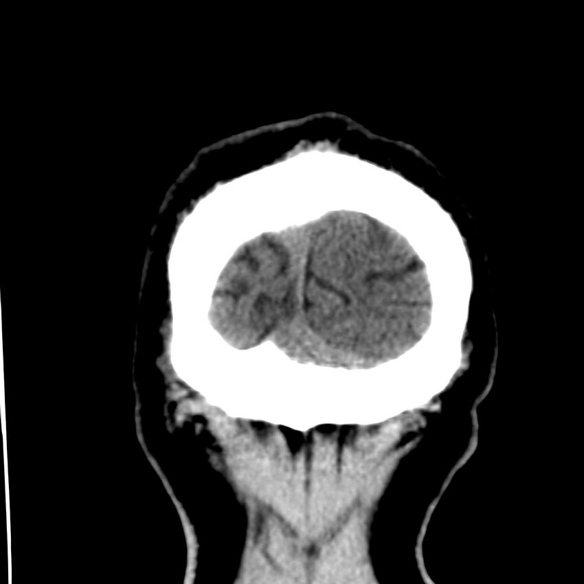 Brain Pantopaque remnants (Radiopaedia 78403-91048 Coronal non-contrast 67).jpg
